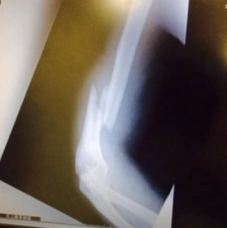 エドワード加藤の腕の骨を骨折したときにレントゲン写真